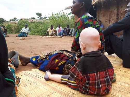 말라위: 살인 부추기는 전통 의술사, 알비노에 대한 공격을 멈춰라!